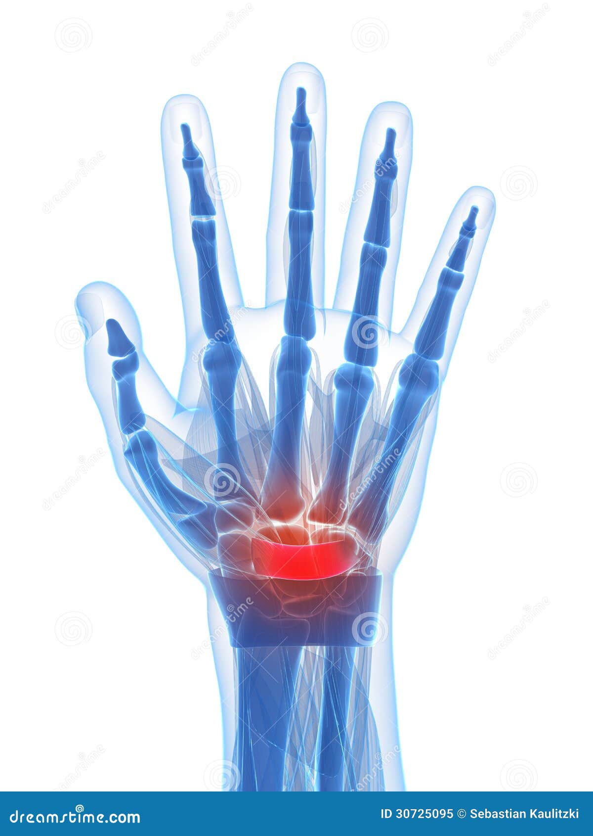 the carpal tunnel syndrome