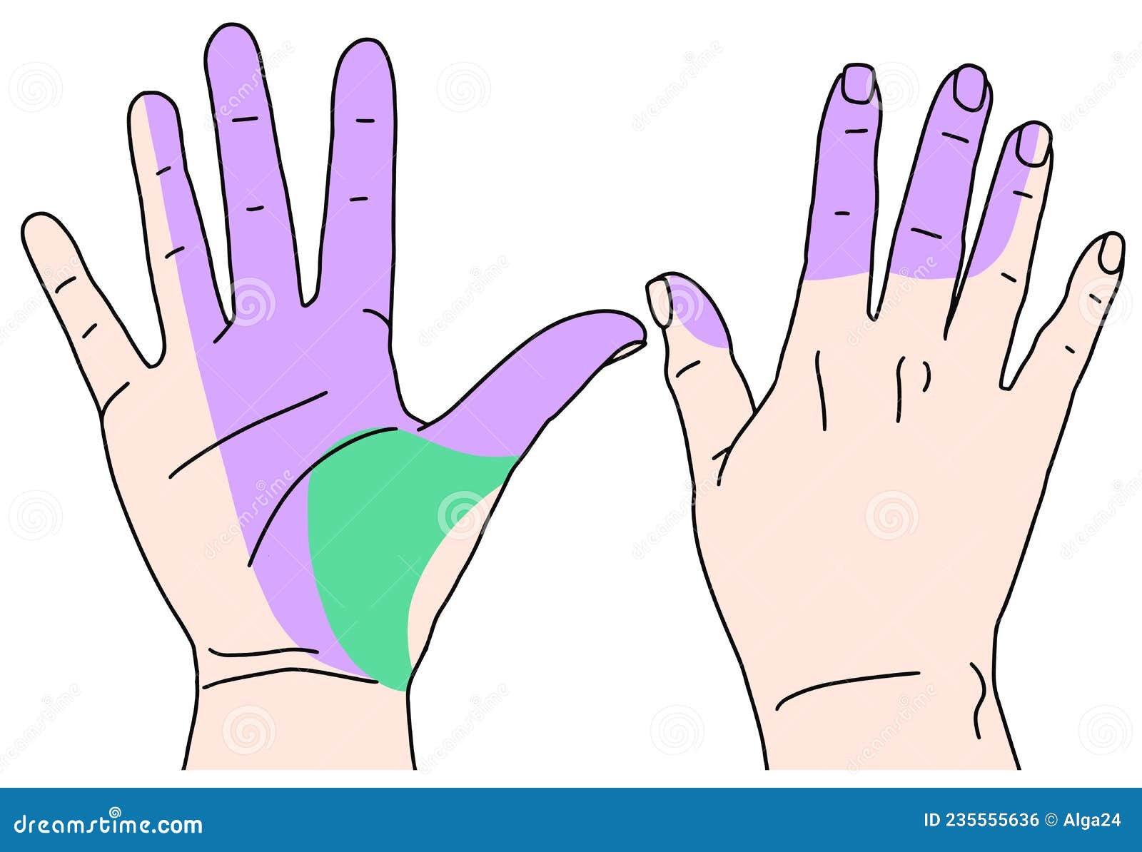 Carpal Tunnel Syndrome Median Nerve Stock Vector - Illustration of peripheral, carpal: 235555636 Carpal Tunnel Syndrome Median Nerve Stock Vector - Illustration of peripheral, carpal: 235555636
