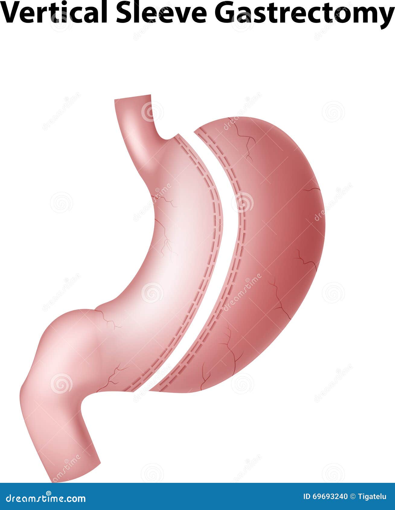 cartoon  of vertical sleeve gastrectomy