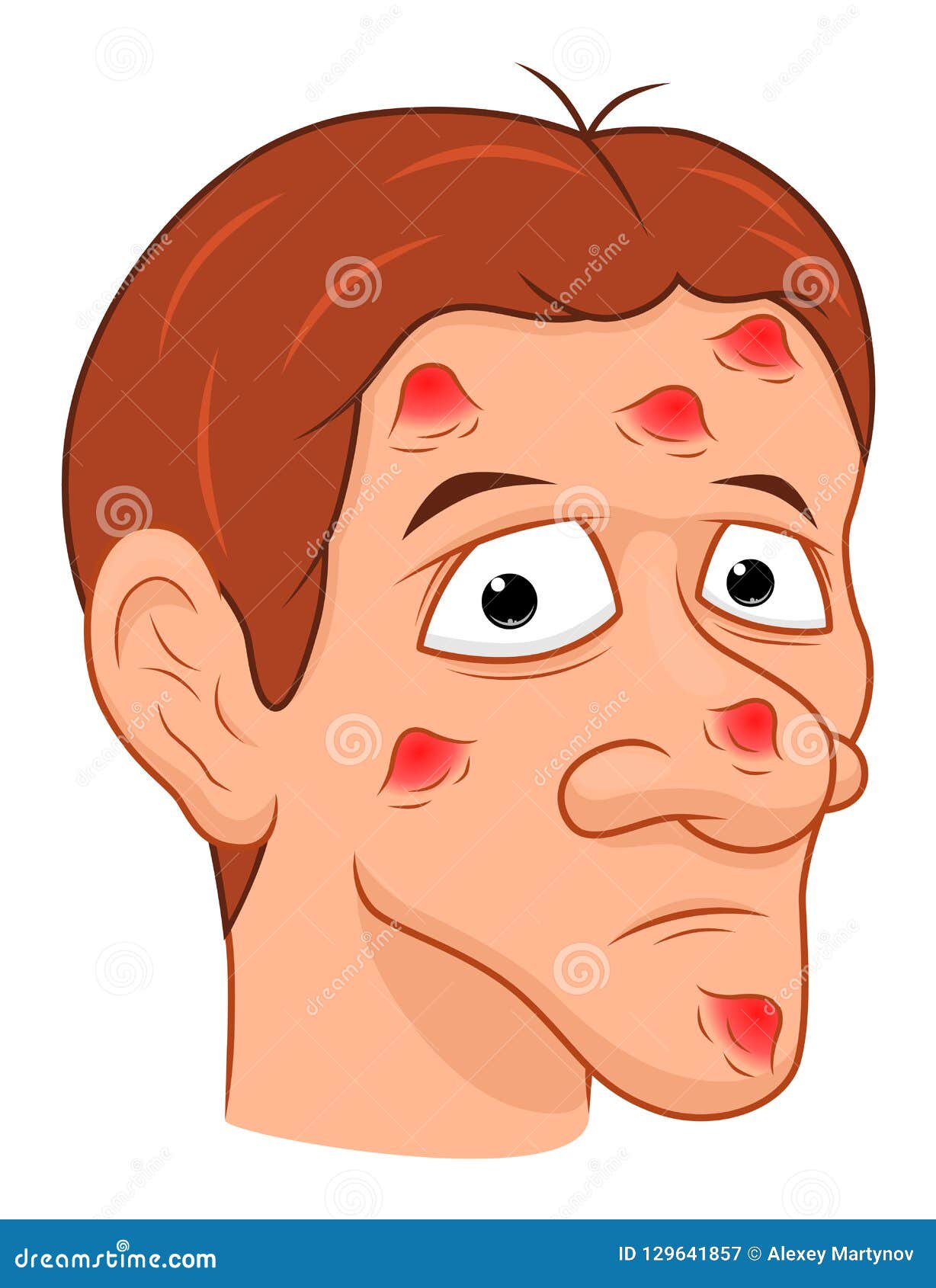  Cartoon  man with acne  stock vector Illustration of skin 
