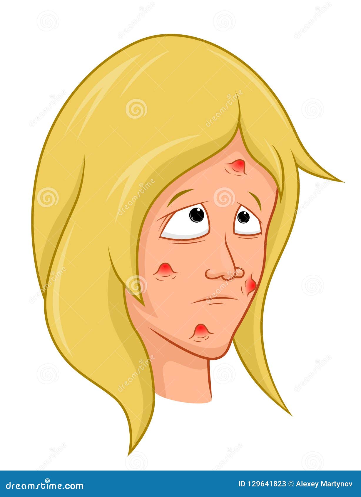  Cartoon  girl with acne  stock vector Illustration of 