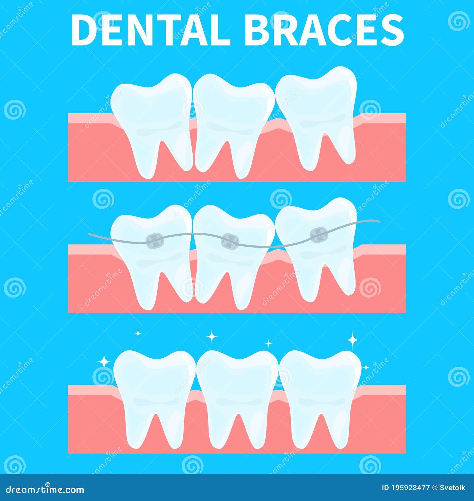 Cartoon Teeth Vector Illustration, before and after Brace Correction. Concept of Ortodontic Treatment Stock Vector - Illustration of bracket, bleach: 195928477 Cartoon Teeth Vector Illustration, before and after Brace Correction. Concept of Ortodontic Treatment Stock Vector - Illustration of bracket, bleach: 195928477