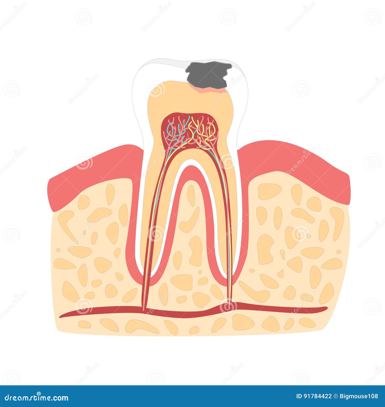 cartoon tooth with stage of dental caries formation. 