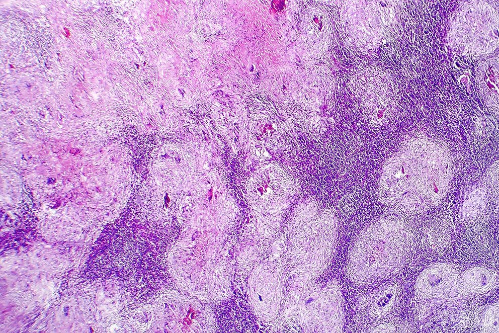 Caseous Necrosis Of Lymphatic Node Stock Photo Image Of Tuberculosis