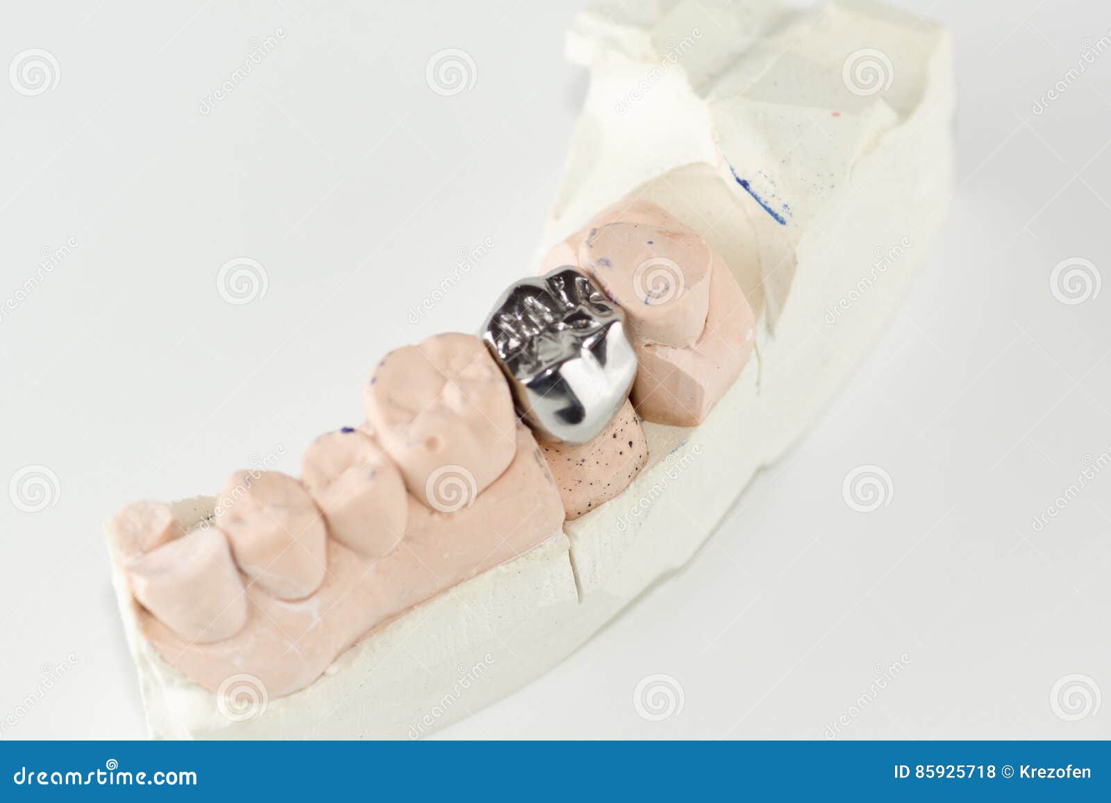 Cast metal dental crown stock photo. Image of smiling 85925718