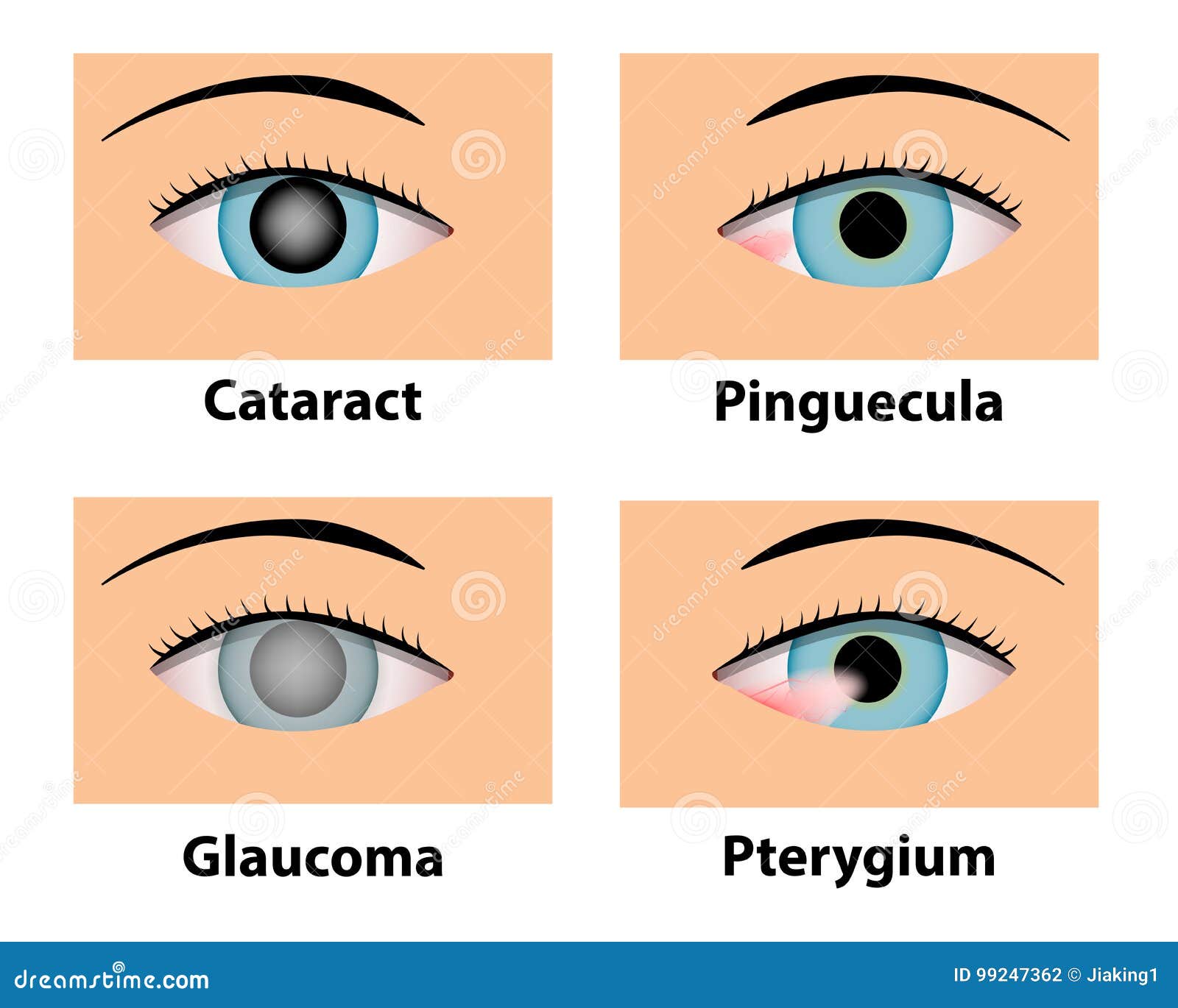 cataract, pinguecula, glaucoma and pterygium, eye care