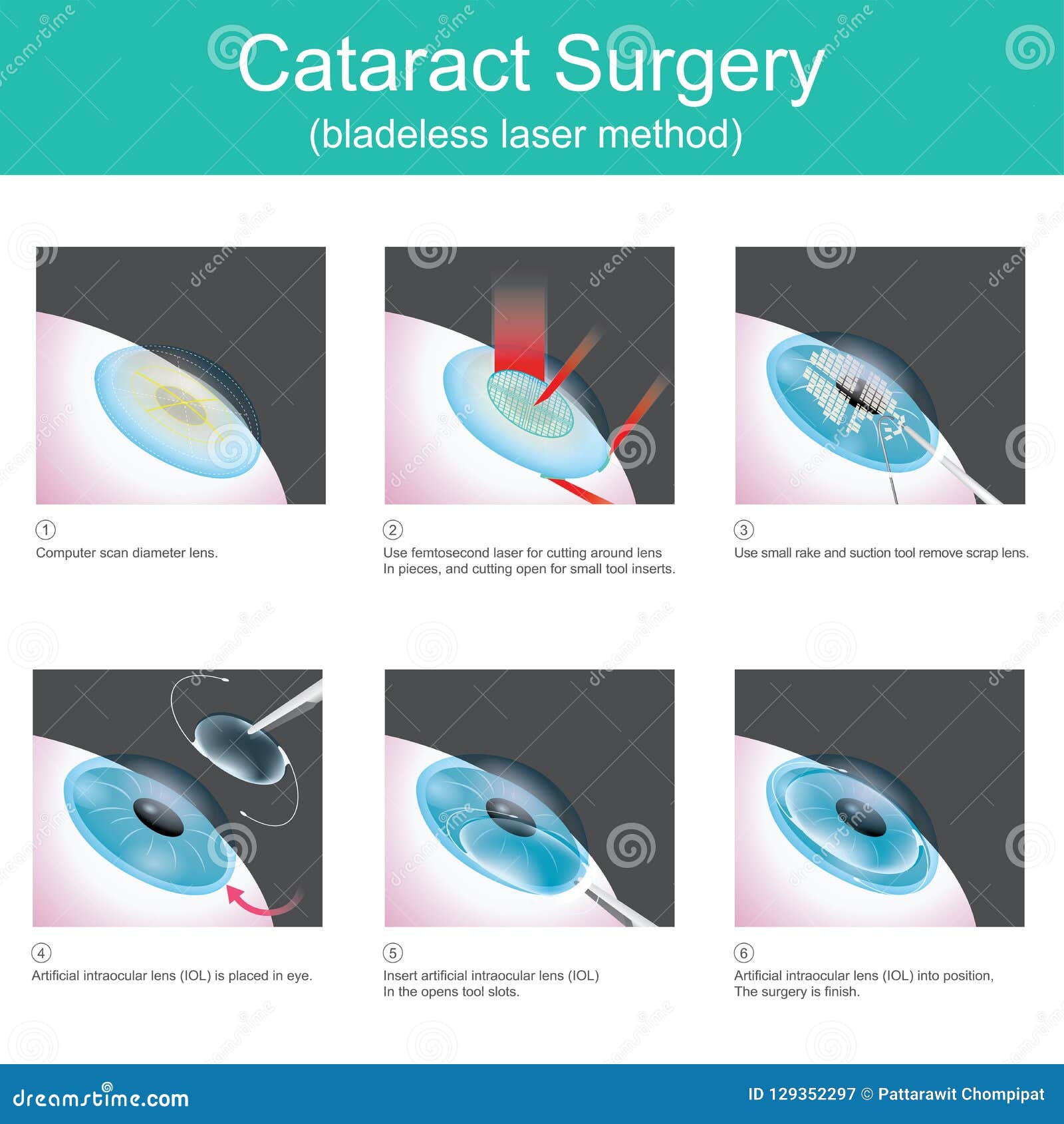 cataract surgery bladeless laser method.