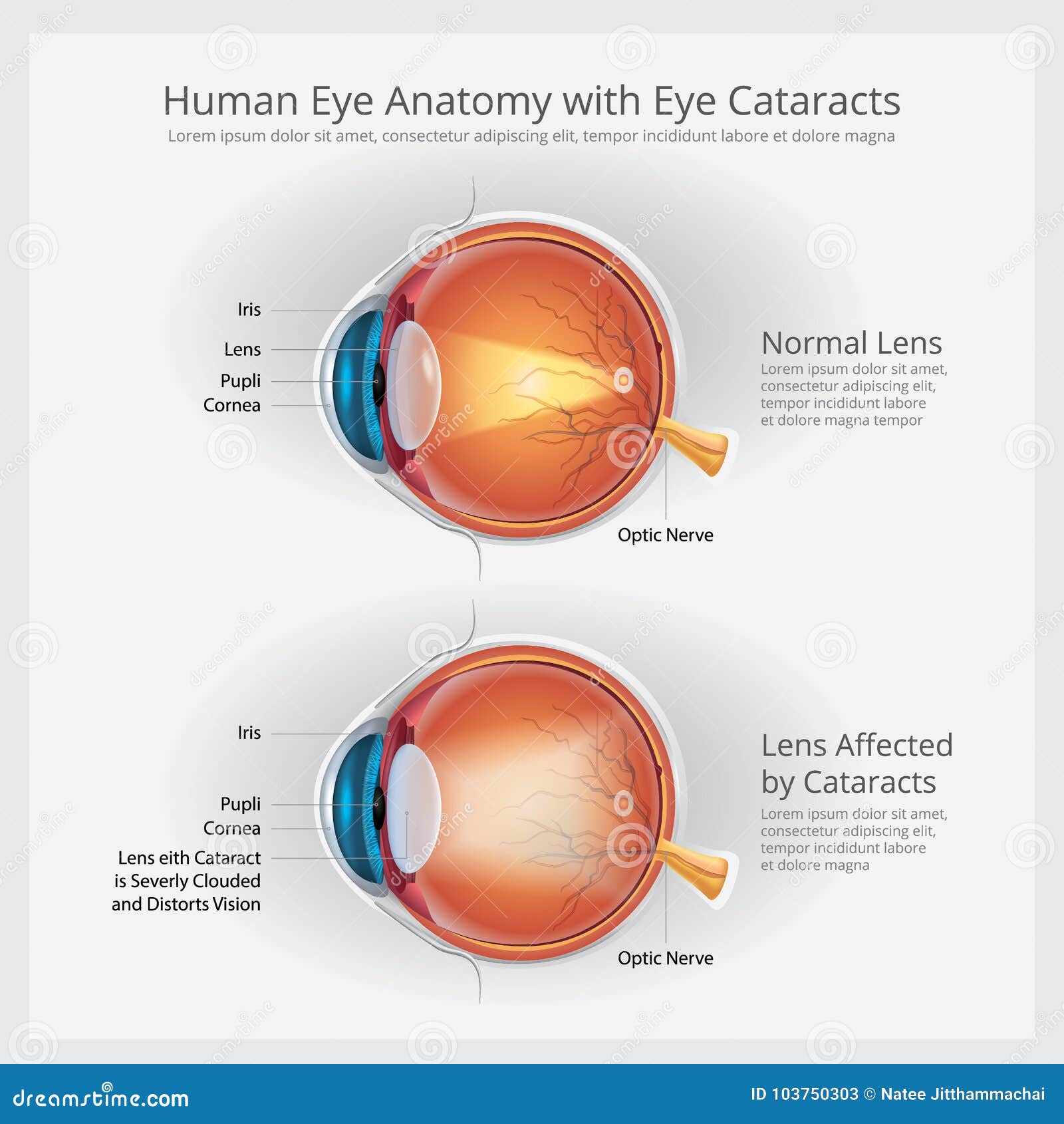Cataracts Vision Disorder and Normal Eye Vision Anatomy Stock Vector