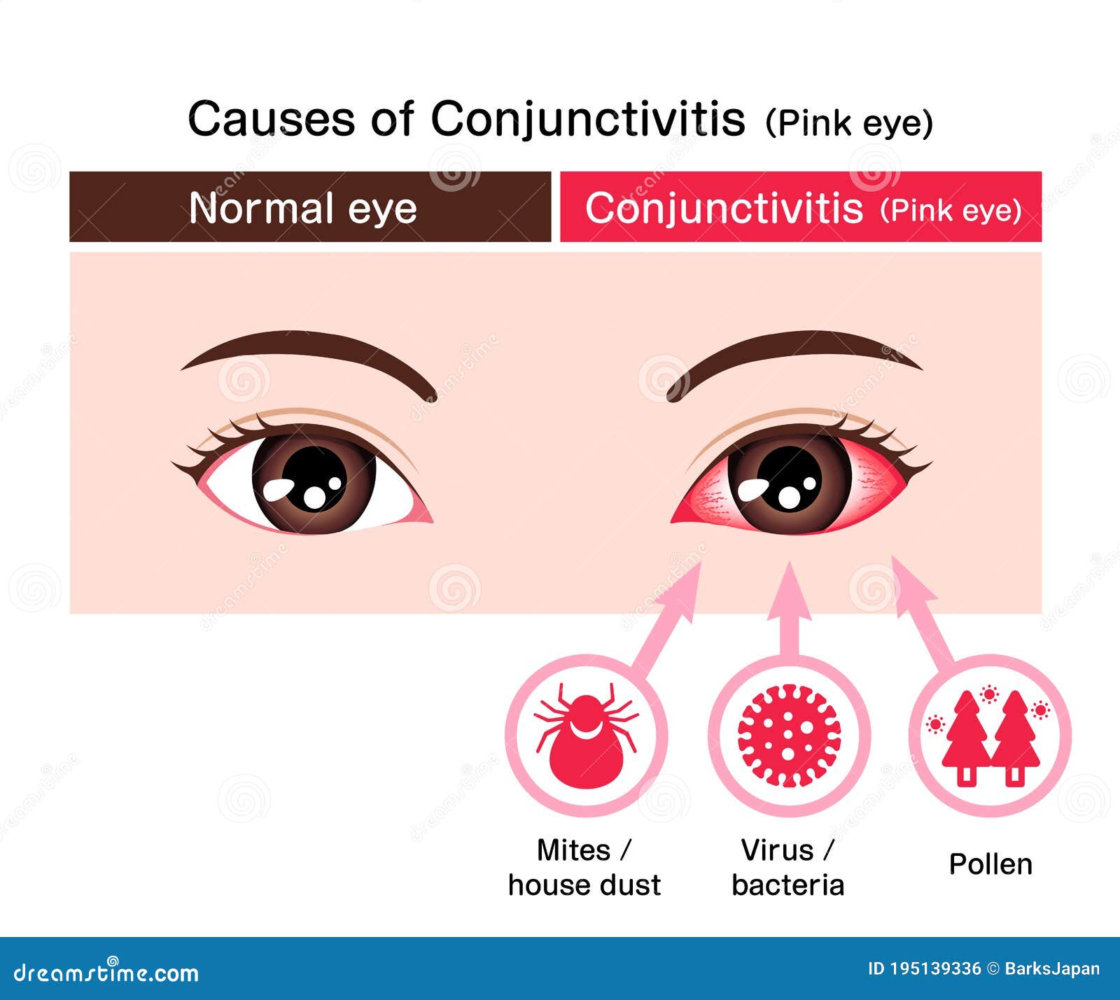 Conjunctivitis Or Pink Eye Symptoms With Simple Explanation Outline