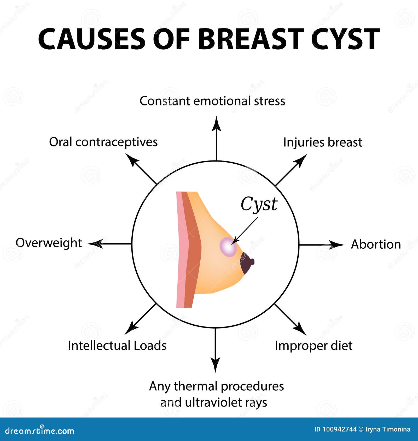 Breast Cyst Women s Health Cartoon Vector CartoonDealer 107581909 breast-cyst-women-s-health-cartoon-vector-cartoondealer-107581909