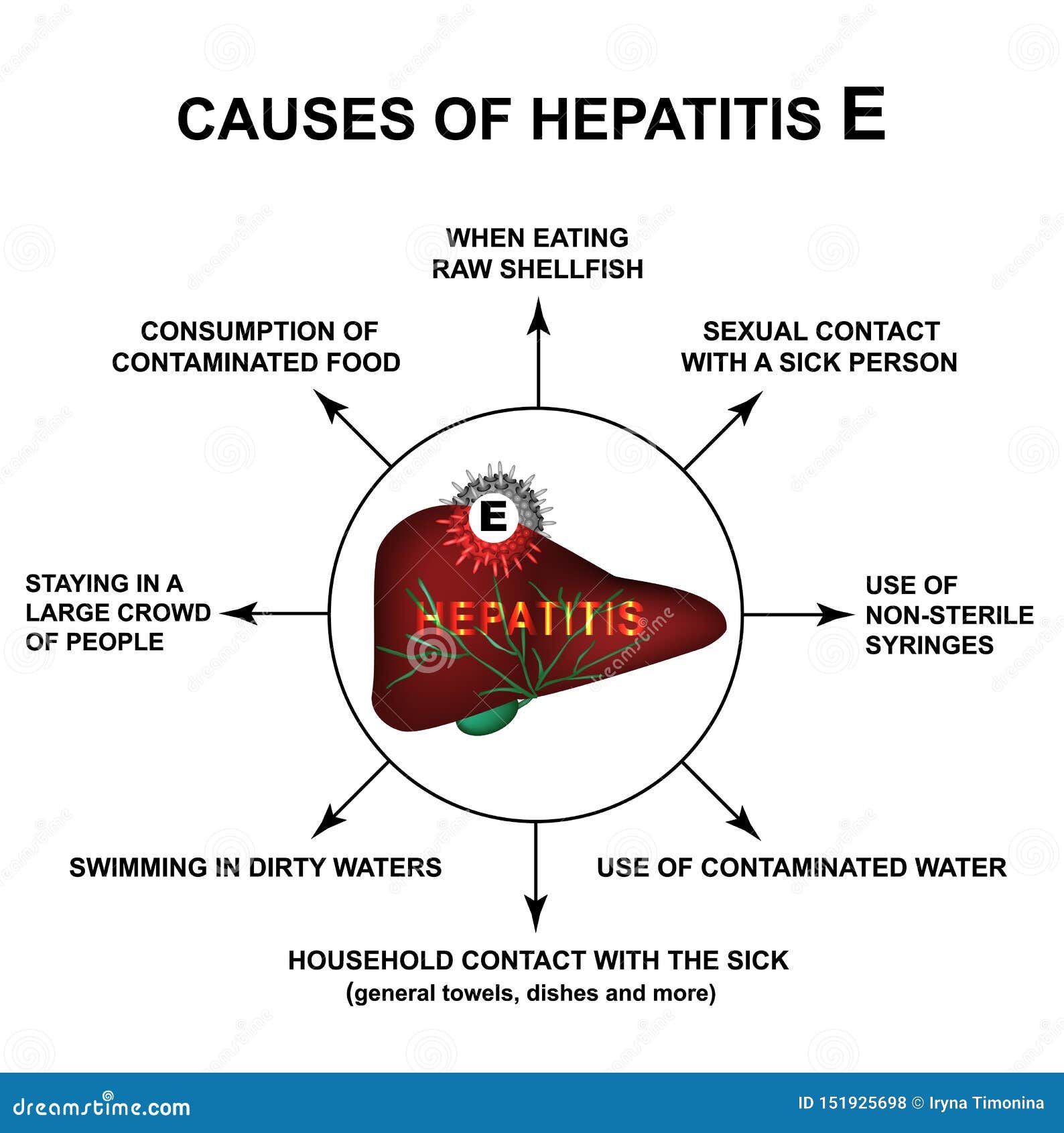 Causes of Hepatitis E. World Hepatitis Day. Infographics. Vector