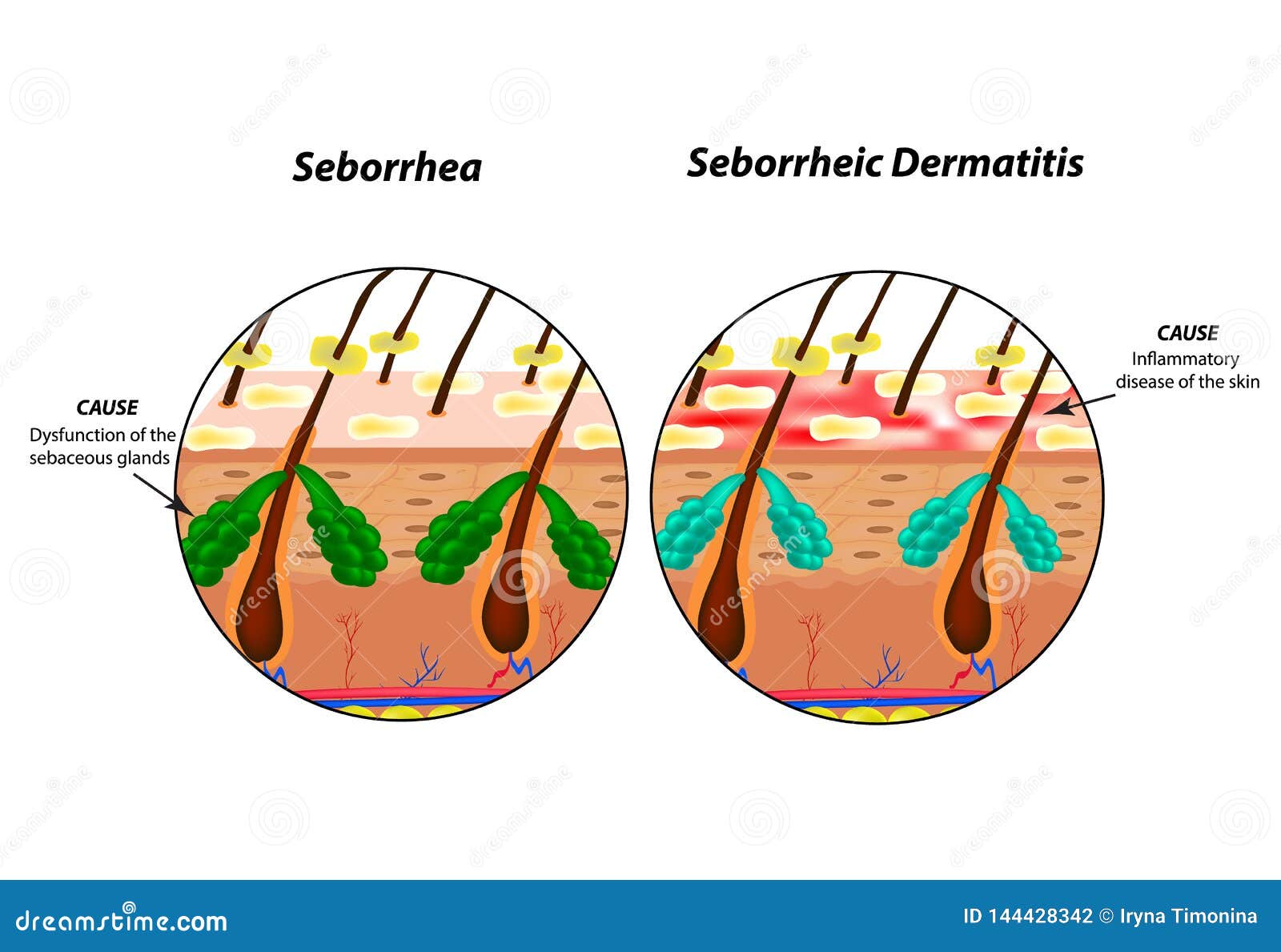 causes seborrhea skin and hair. dandruff seborrheic dermatitis. eczema. dysfunction of the sebaceous glands