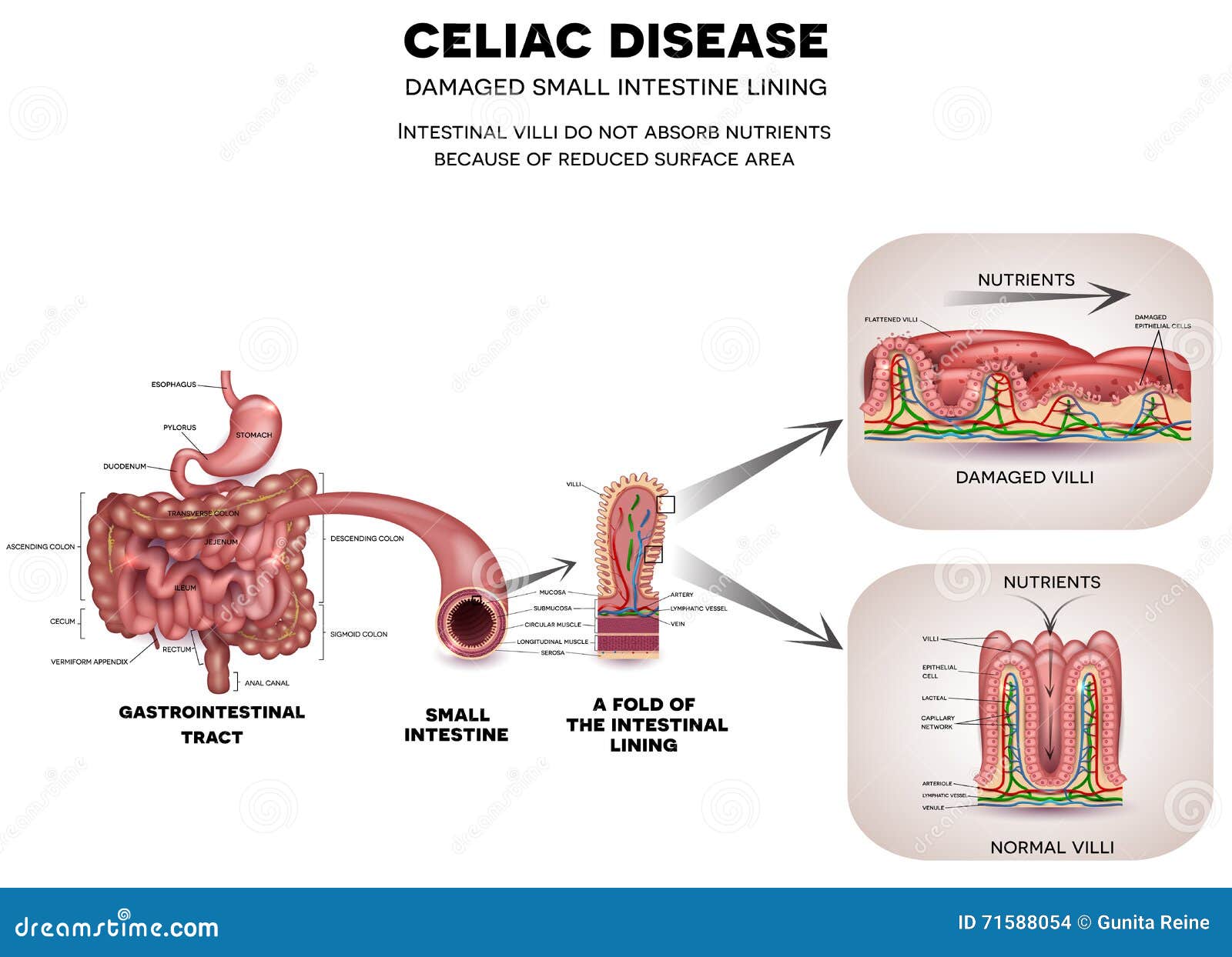 celiac disease