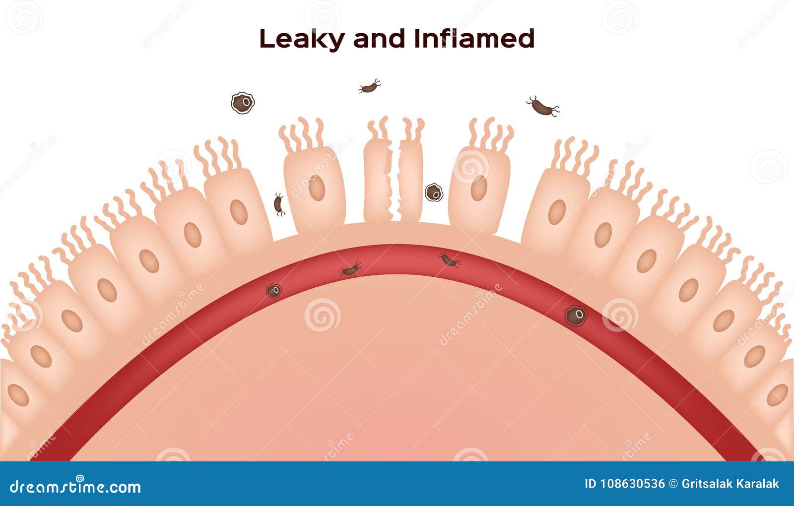 celiac disease small intestine lining damage. good and damaged villi . leaky gut progression