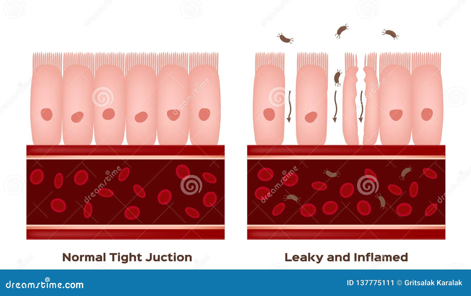 celiac disease small intestine lining damage. good and damaged villi . leaky gut progression