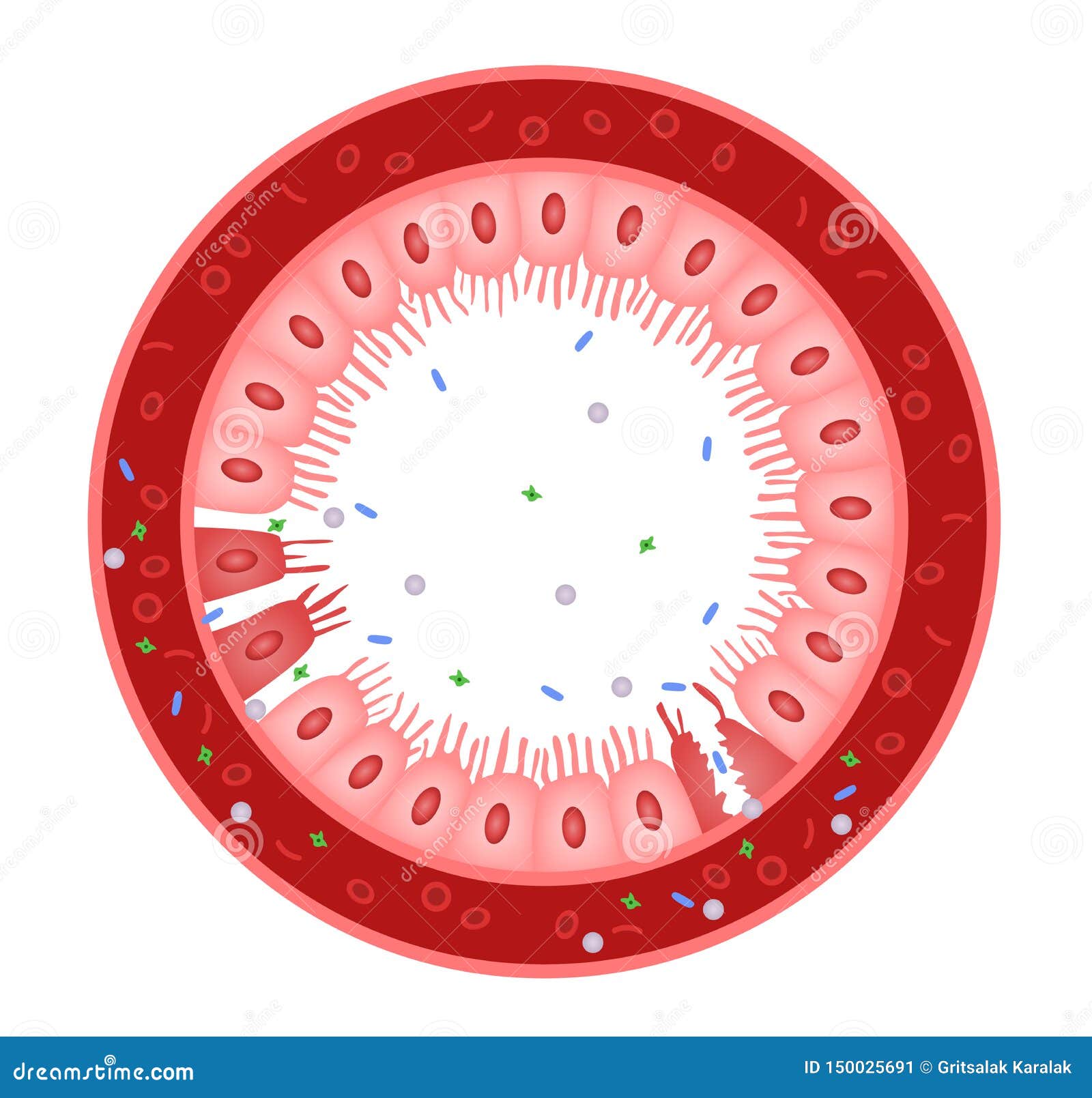 celiac disease small intestine lining damage. good and damaged villi . leaky gut progression