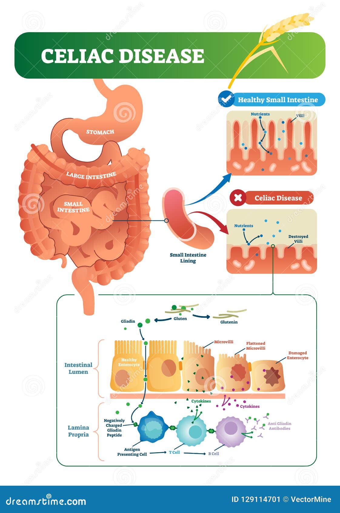 Celiac Disease Cartoon Vector CartoonDealer 68777679 celiac-disease-cartoon-vector-cartoondealer-68777679