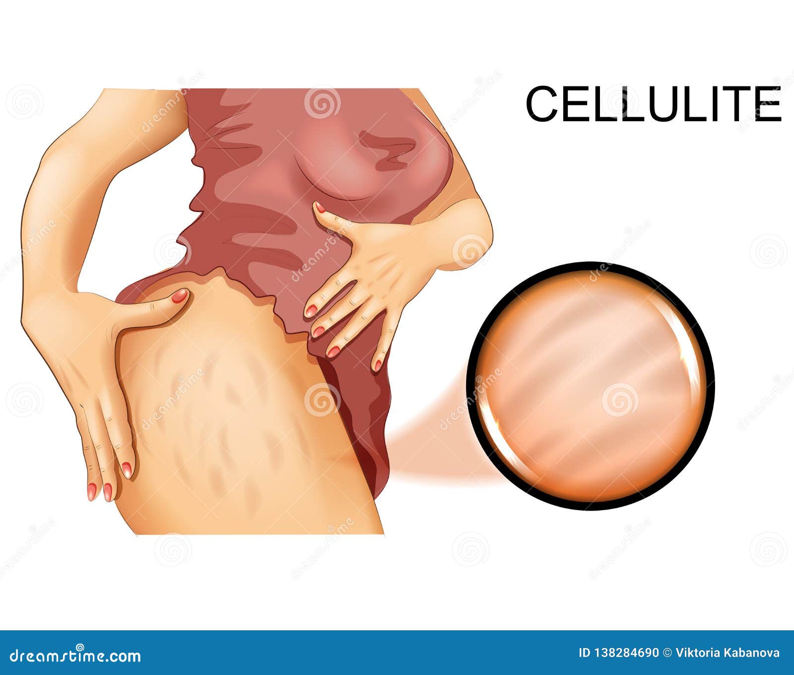 cellulite on a woman`s thigh