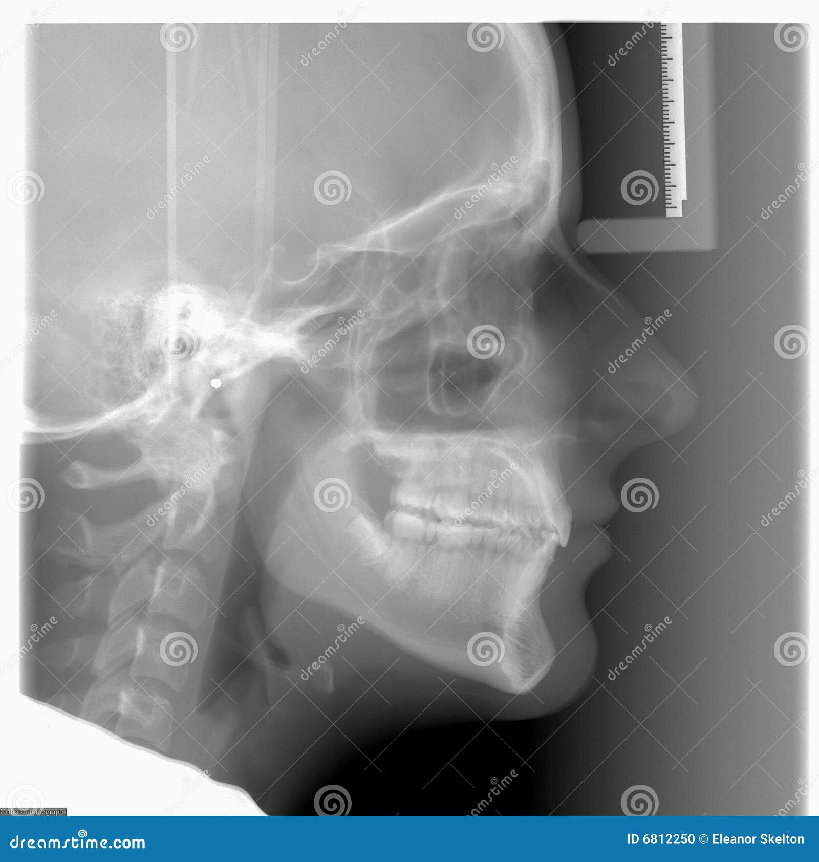 cephalometric x-ray used in dentistry and orthodontics