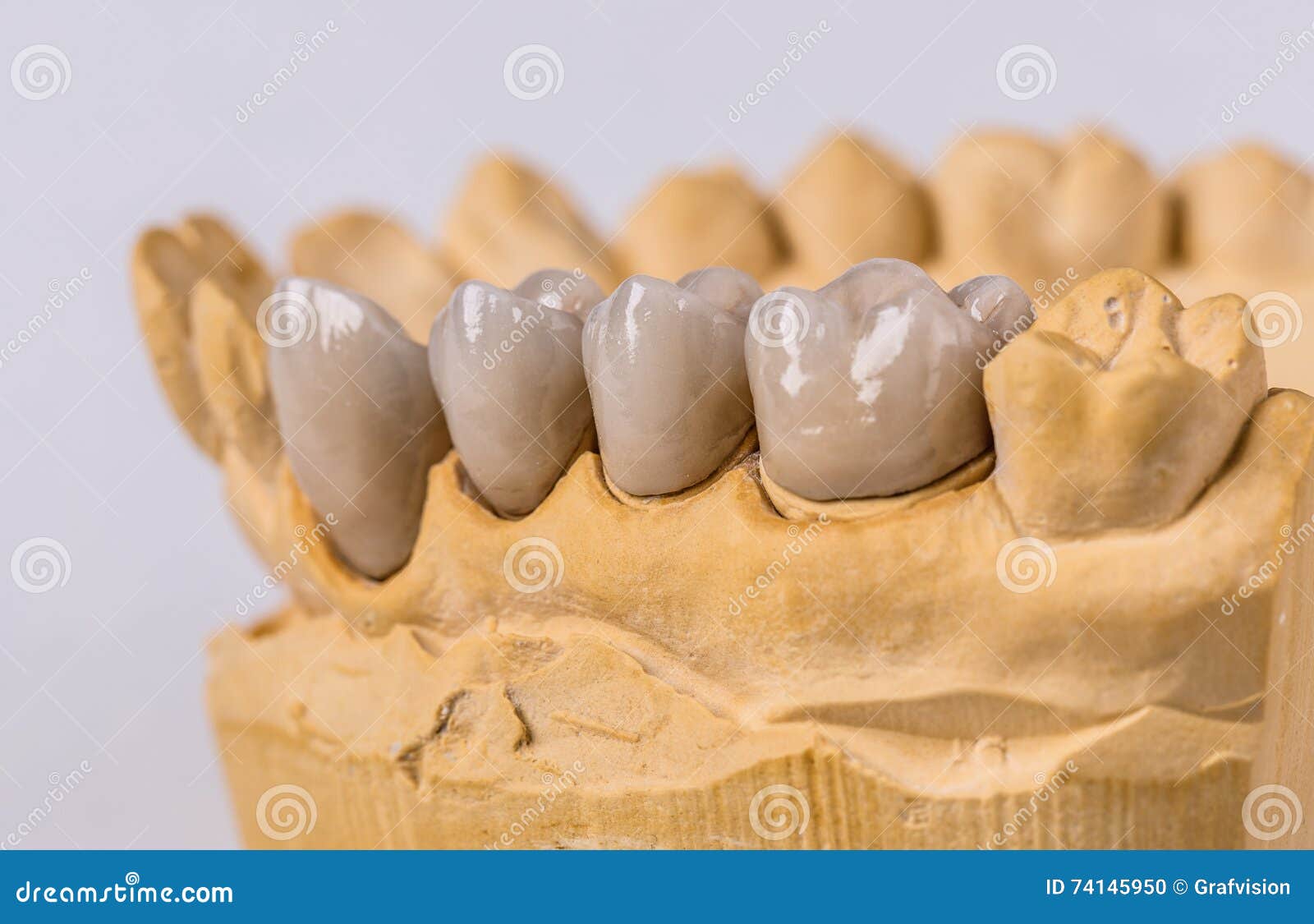 Ceramic dental implants stock photo. Image of orthodont 74145950