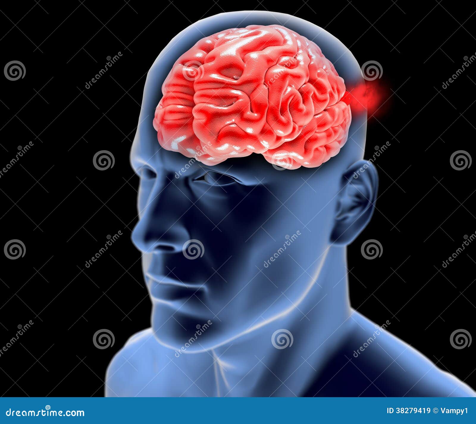 cerebral aneurysm, brain head