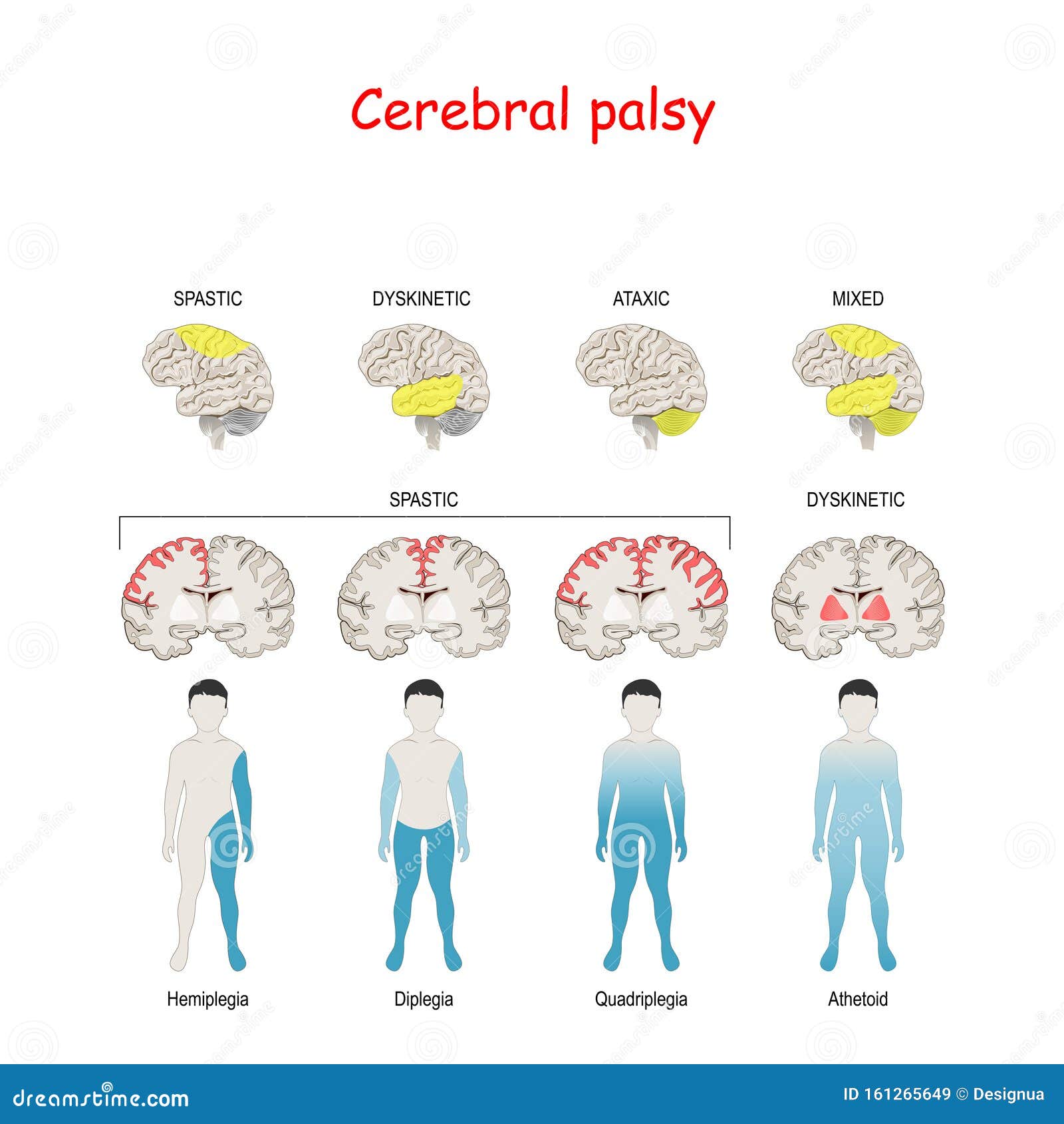 Cerebral Palsy Diagram