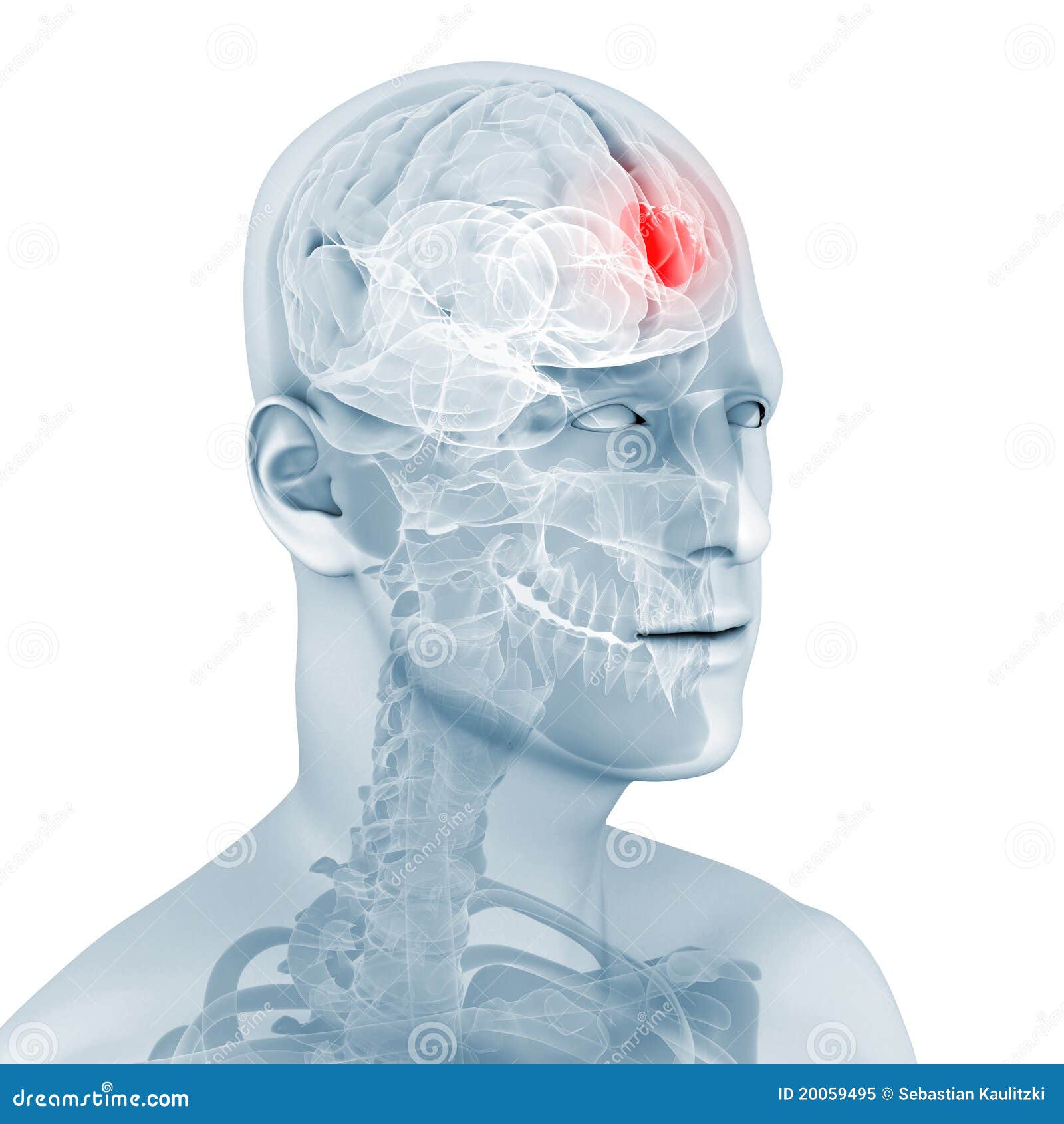 cerebral tumor