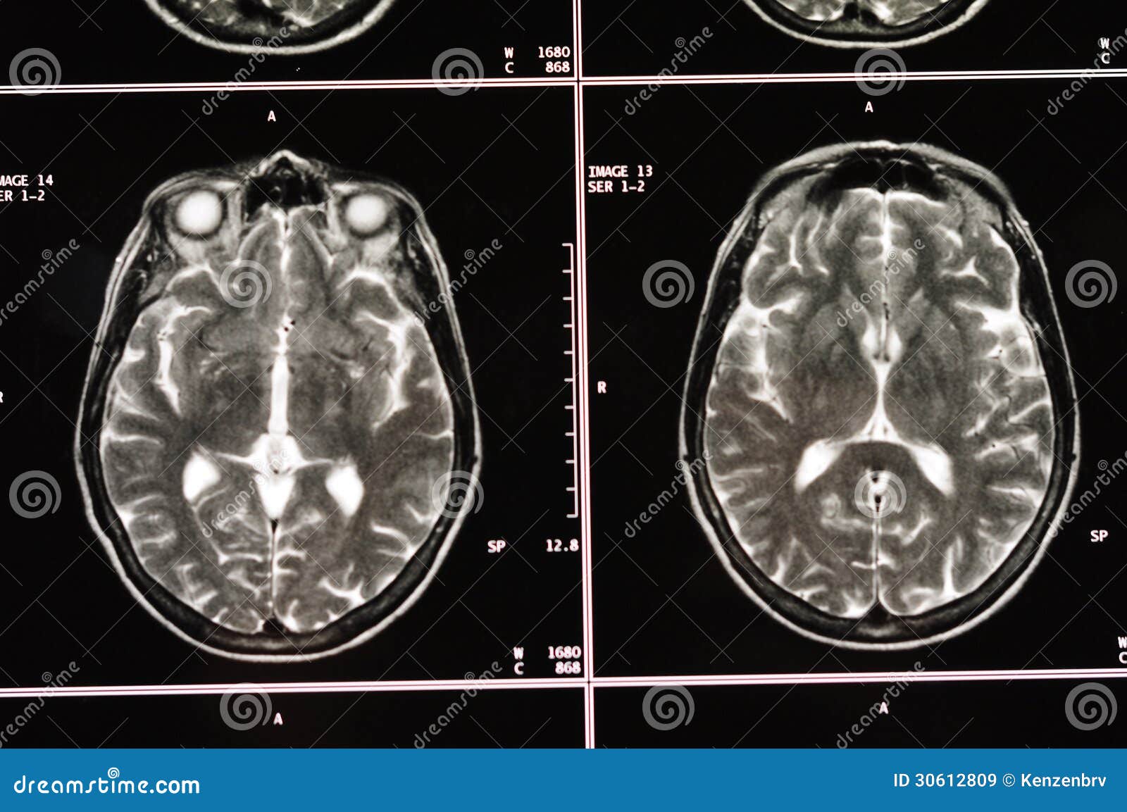 Cerebro MRI. Tomografía del cerebro. Imagen radiológica. Imagen de resonancia magnética