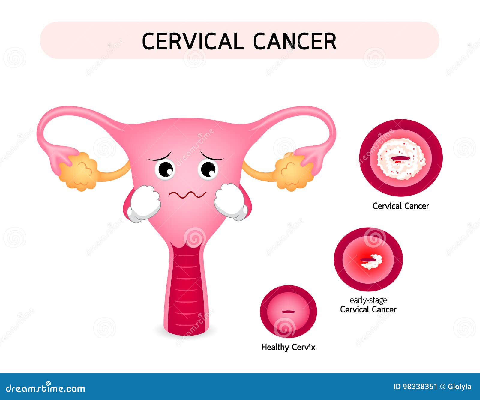 Cervical Cancer Diagram With Sadness Uterus Cartoon Character Cartoondealer Com