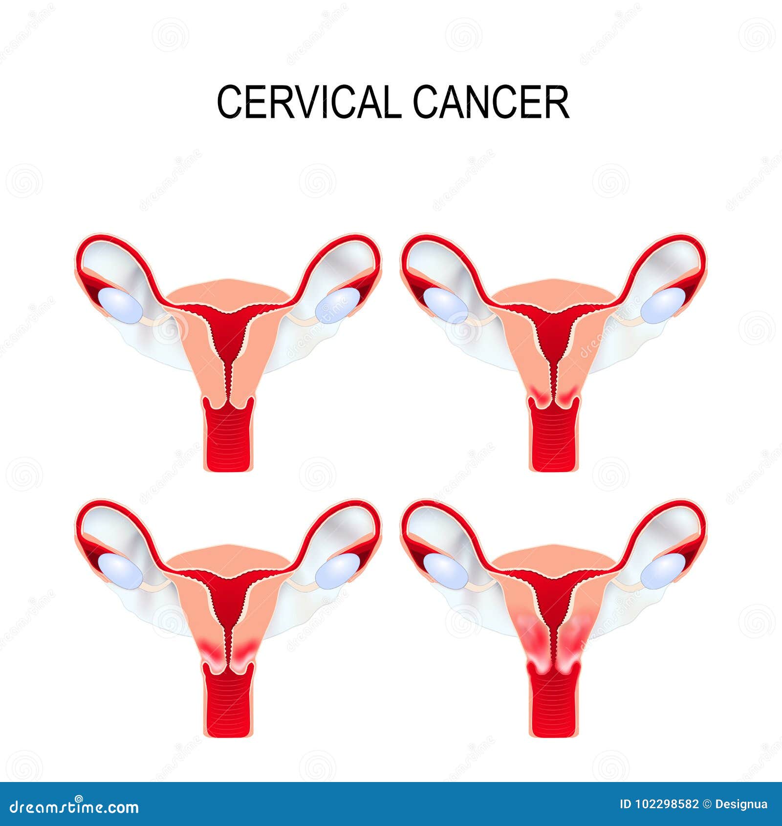 cervical cancer staging. carcinoma of cervix.