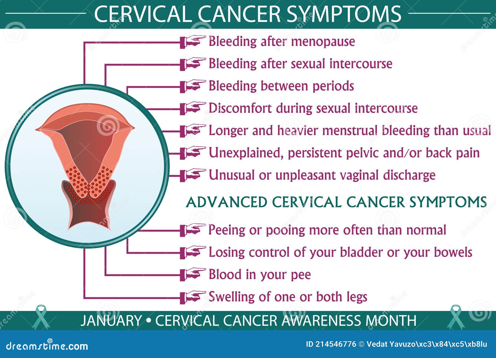 Cervical Cancer Symptoms Infographic Vector Illustration ...