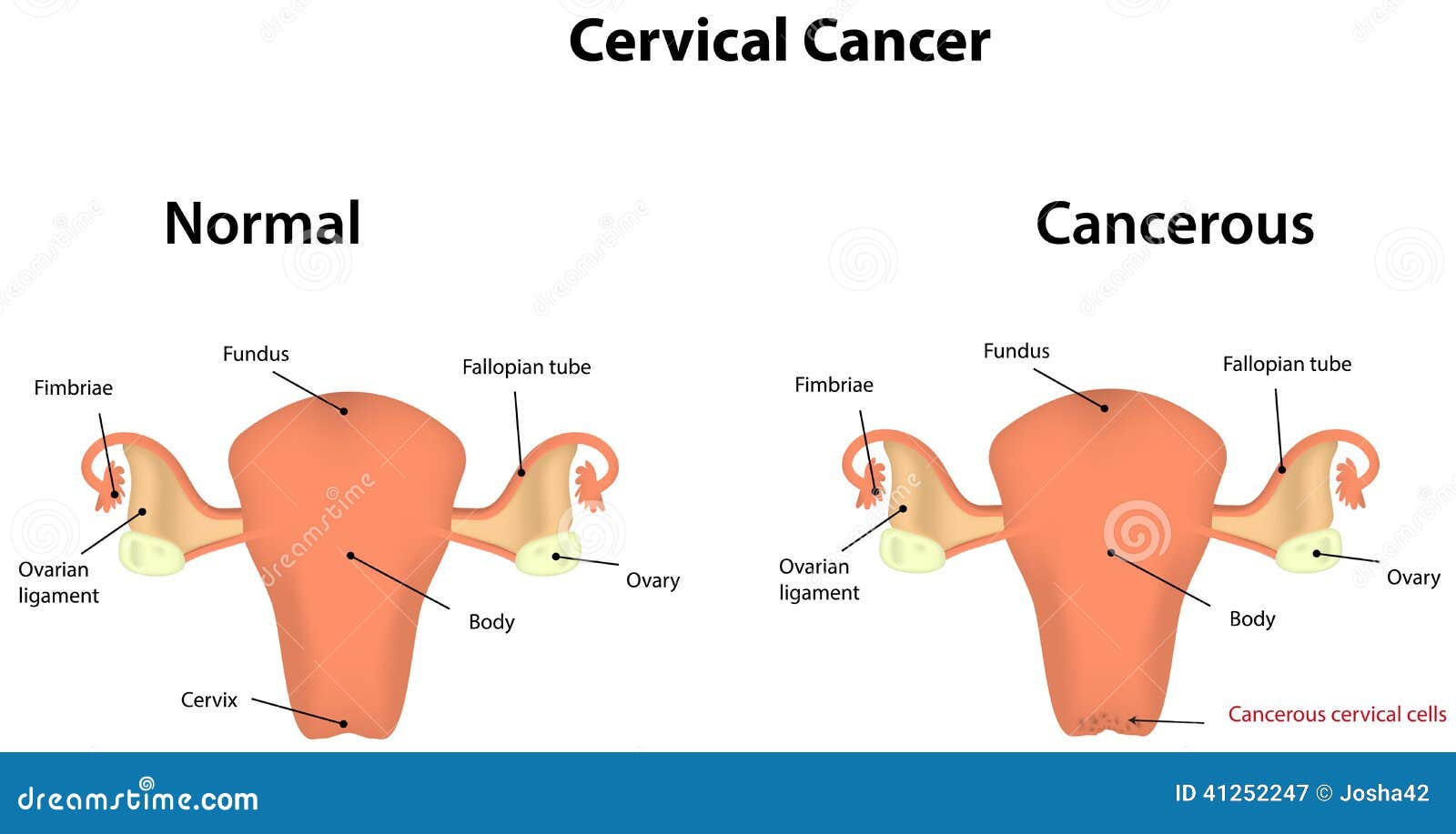 Cervical Cancer Illustration