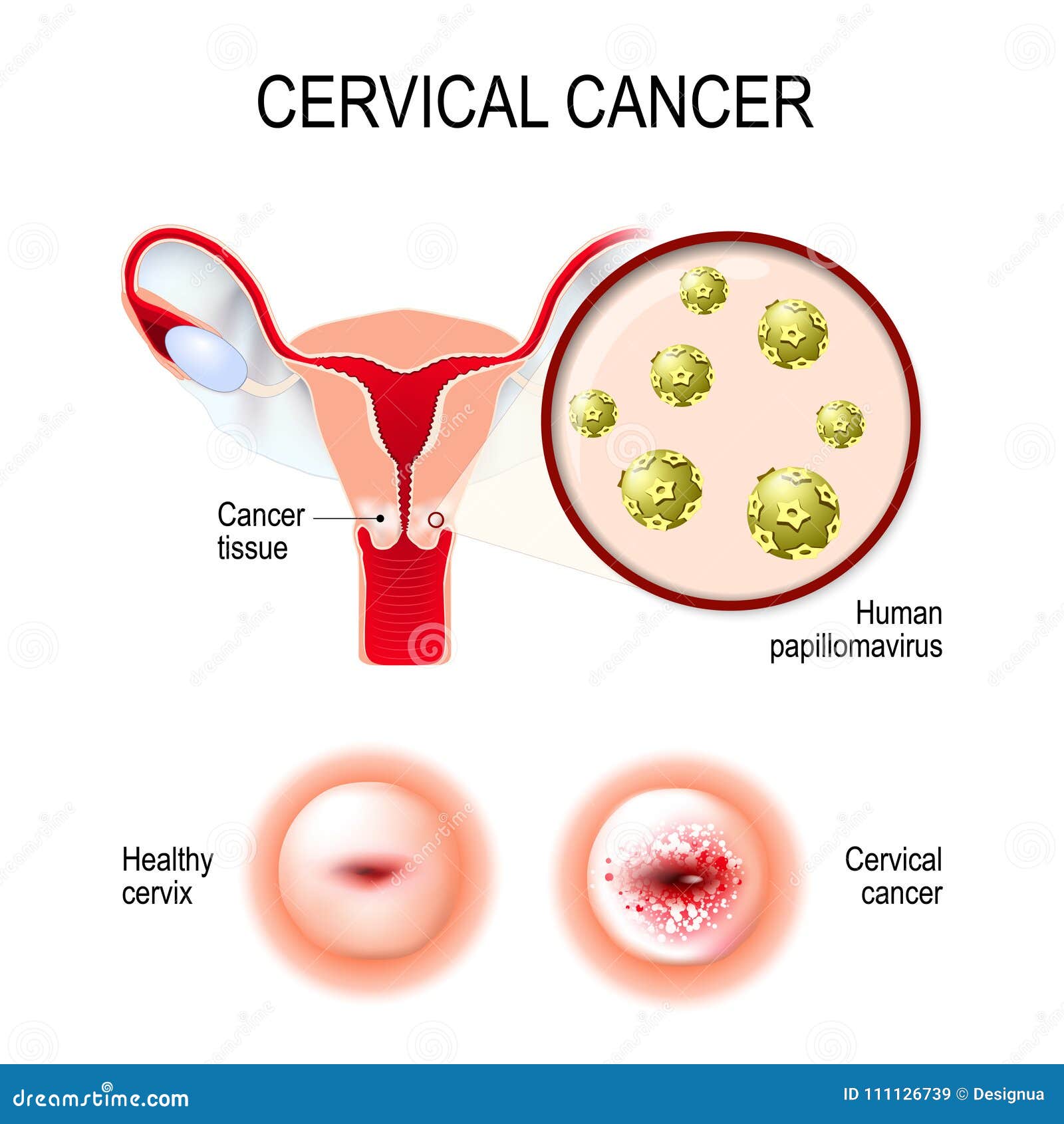 HPV (Papiloma Virus Uman) ADN-genotipare