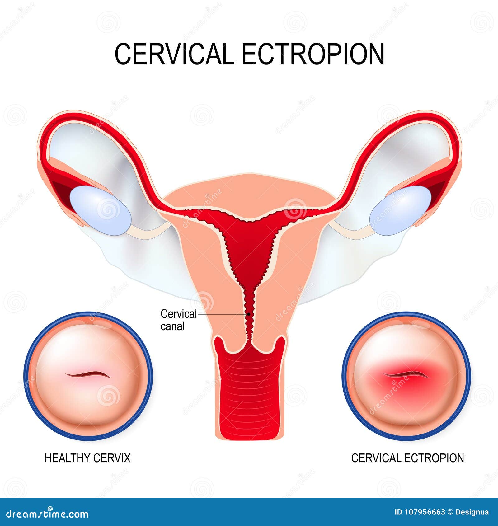 Cervical ectropion stock illustrations 5 cervical ectropion stock