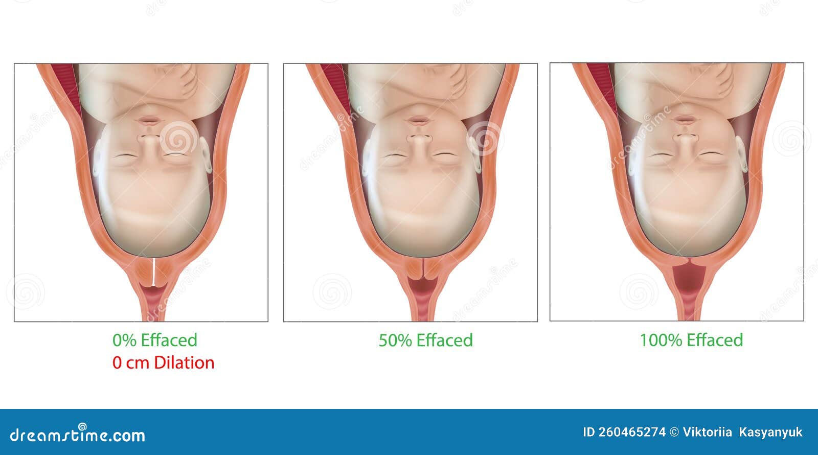 Cervical Effacement And Dilation During Delivery Cervix Labor Or cervical-effacement-and-dilation-during-delivery-cervix-labor-or