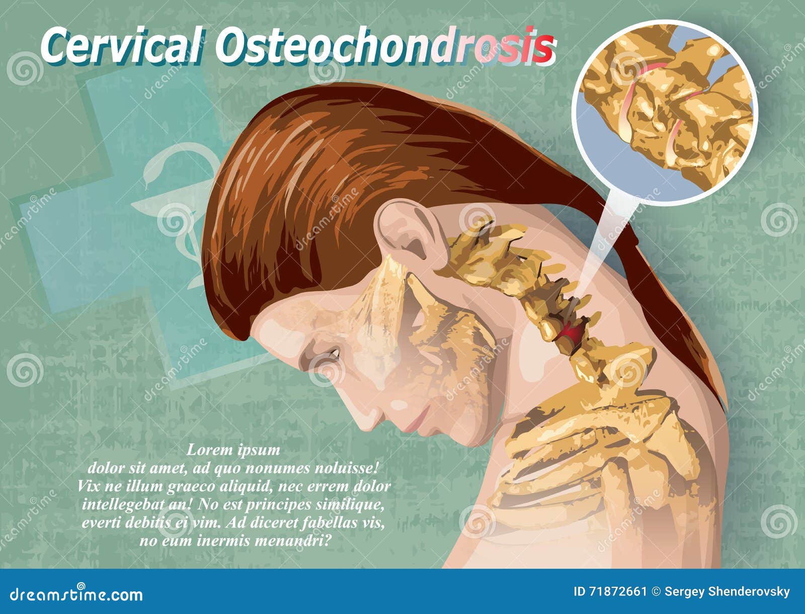 Cervical osteochondrosis c5 6, Osteochondrosis neck pain