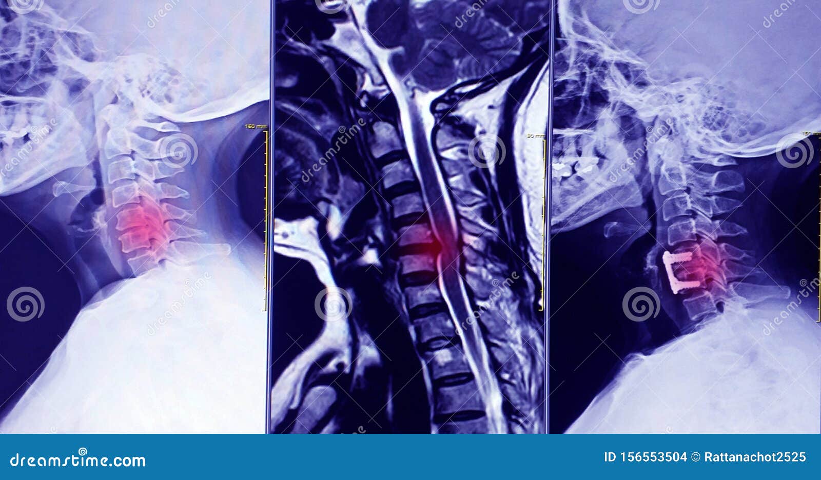cervical spine 3 views x-ray cervical spine three views finding internal fixation c4-c5 & c6 with plate & screws and there is hype
