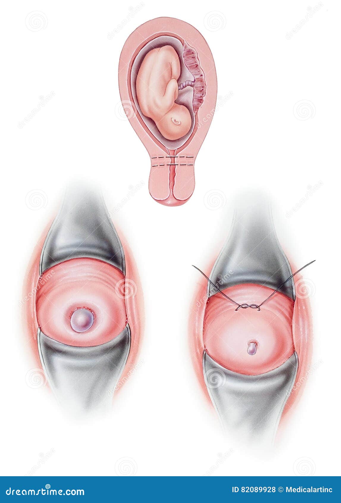 cervix cervical cerclage surgery used to keep incompetent closed pregnancy shown area treatment top 82089928