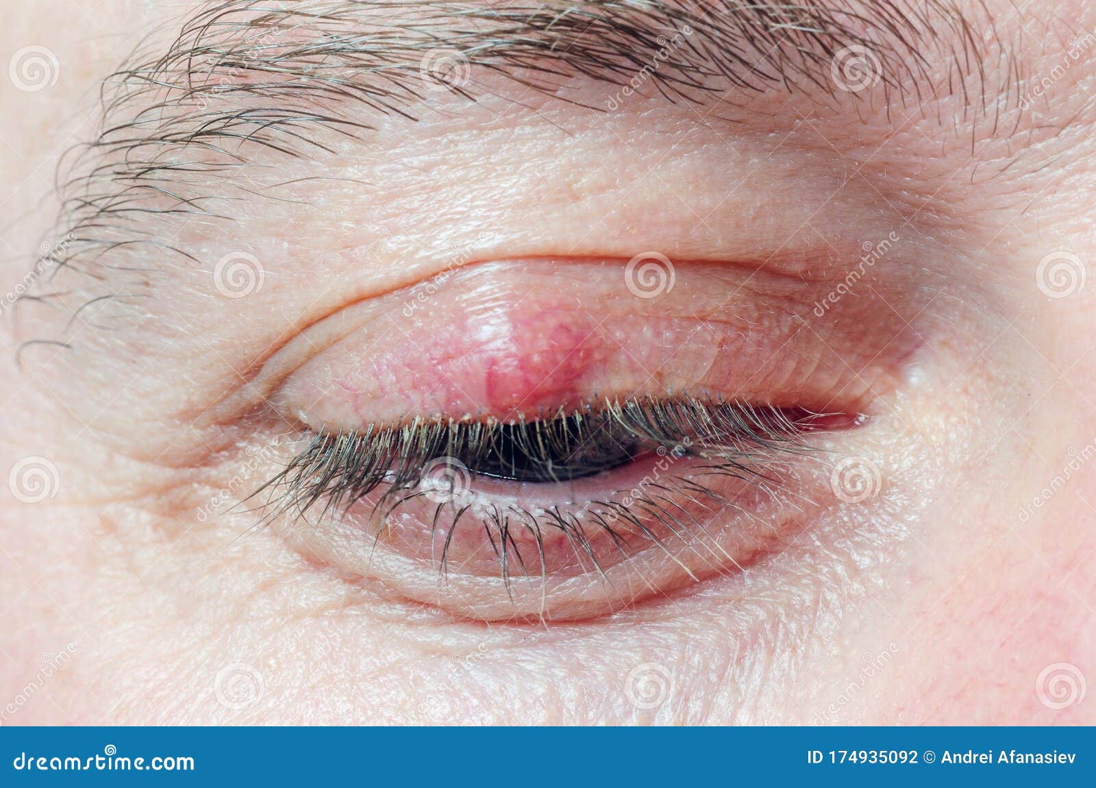 Chalazion On The Eyelid Of A Man Close Up Stock Photo Image Of Pain