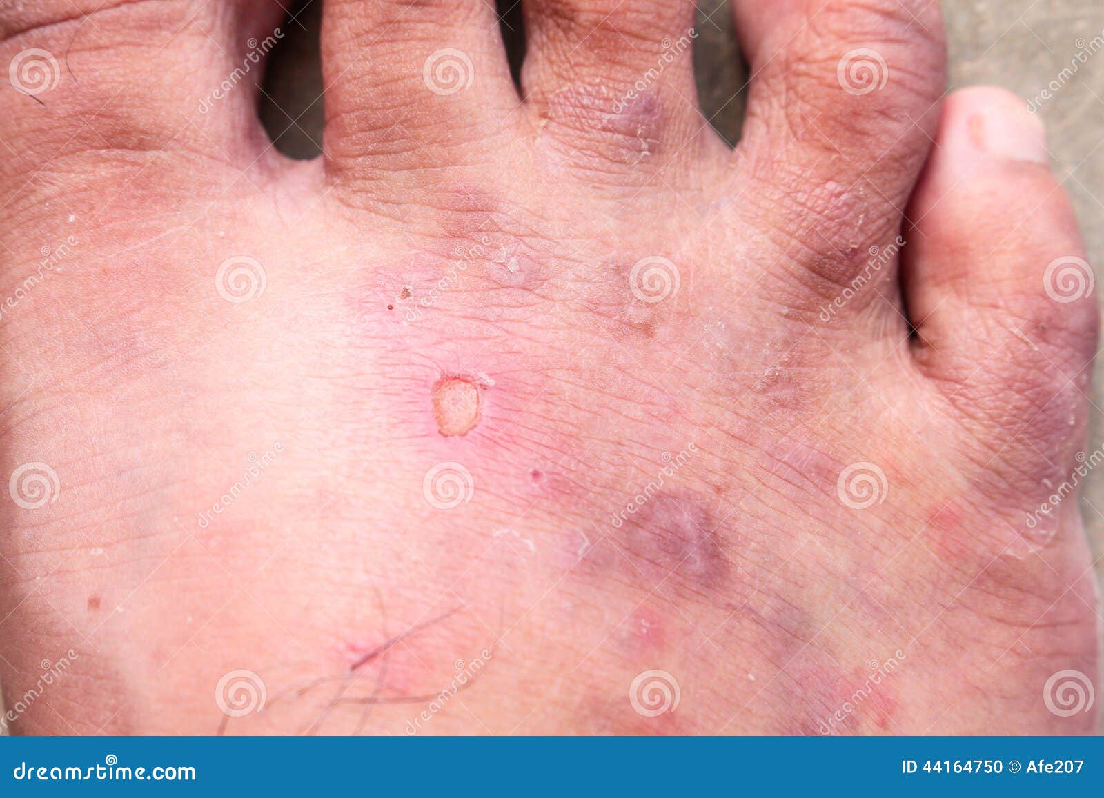 Champignon De Psoriasis De Pied D Athletea S De Peau De Plan Rapproche Pied De Hong Kong Photo Stock Image Du Sante Athletes