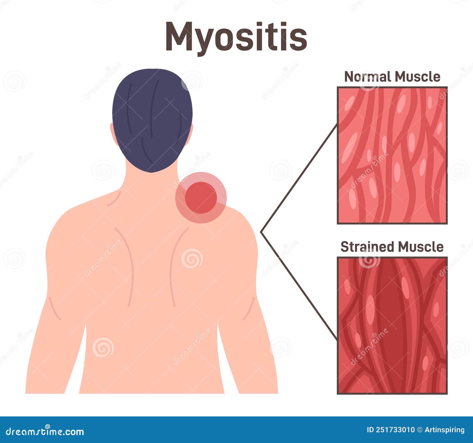 Myositis