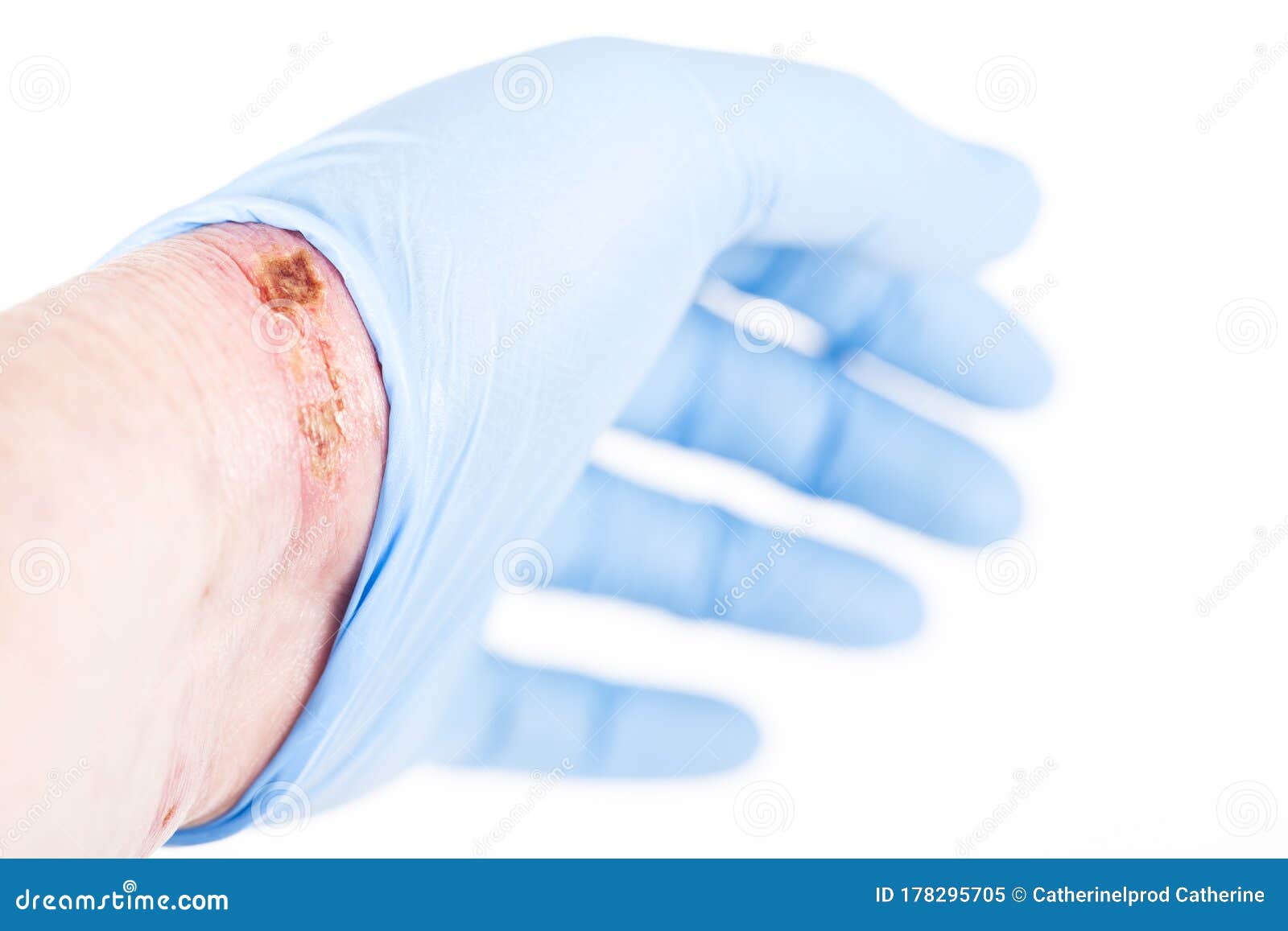 chemical burn on hands chemical burn on hands