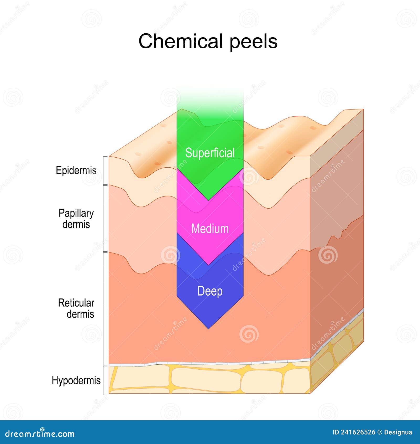 chemical peel. skin layers