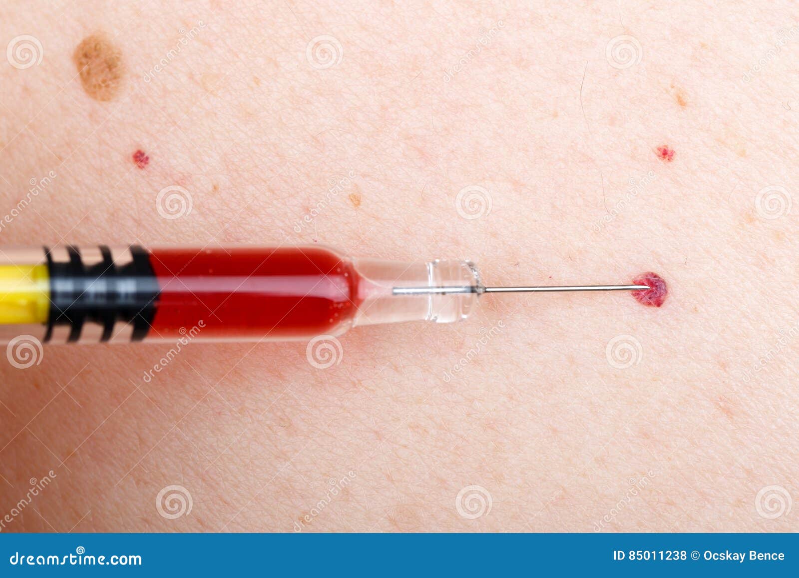 Cherry angioma and nevus stock photo. Image of brown 85011238