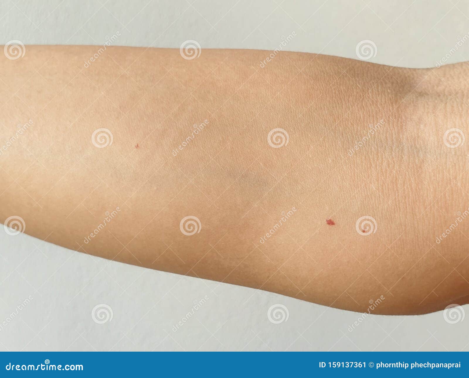 Himmel lukke godt Cherry Angiomas Red Mole, Red Mark on Arm Skin, Red Dot Suddenly Appeared.  Cherry Hemangioma on Arm Stock Image - Image of pigment, body: 159137361