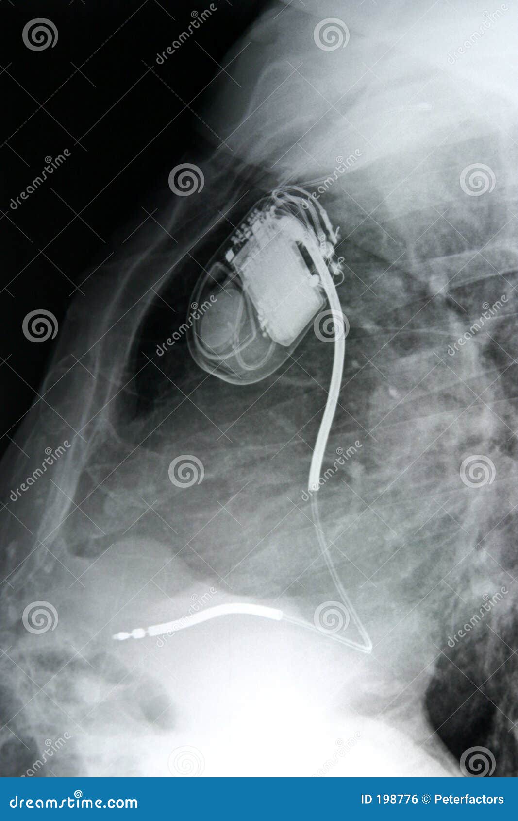 chest+pacemaker/side
