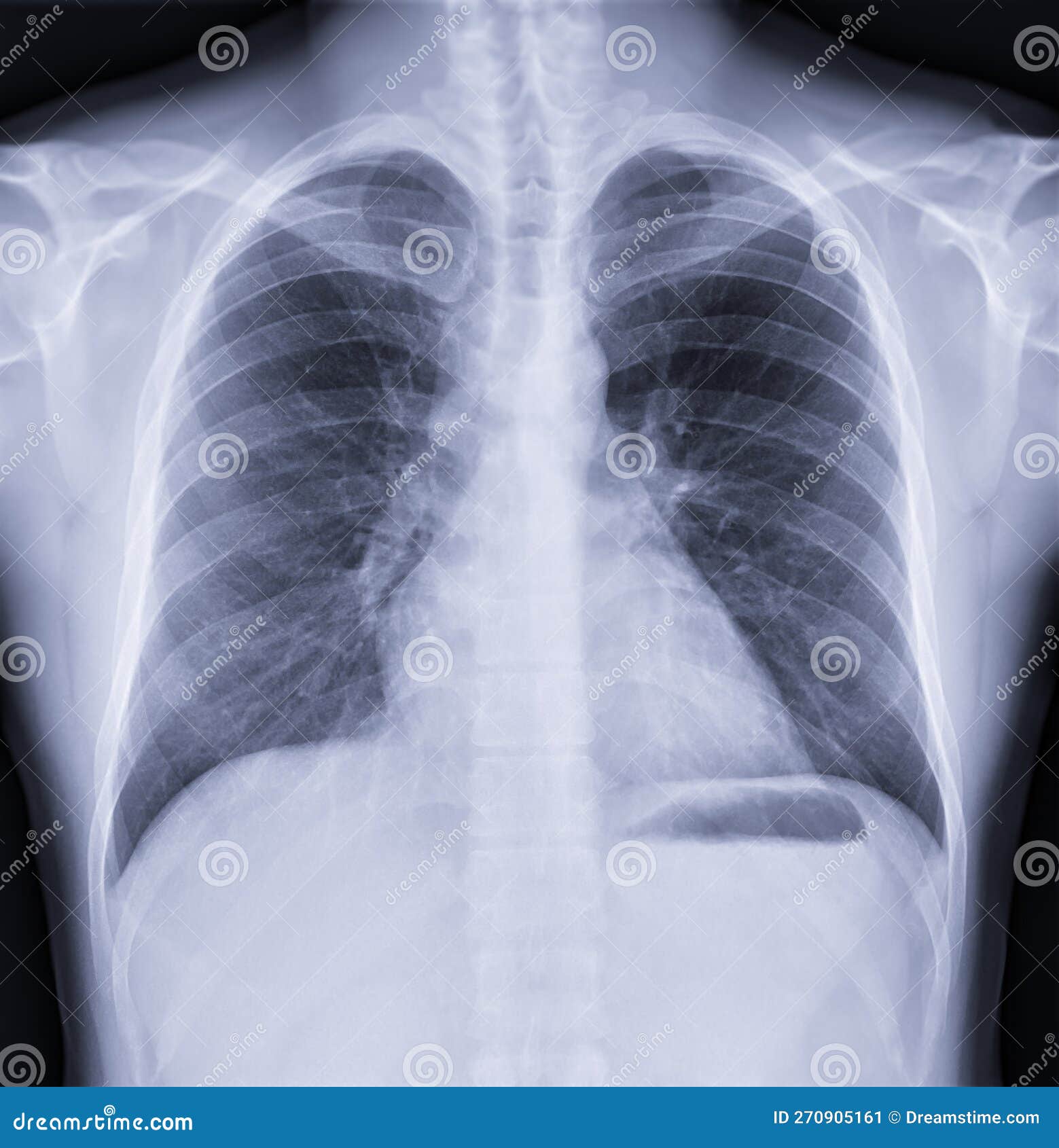 Chest Xray Normal chest-xray-normal