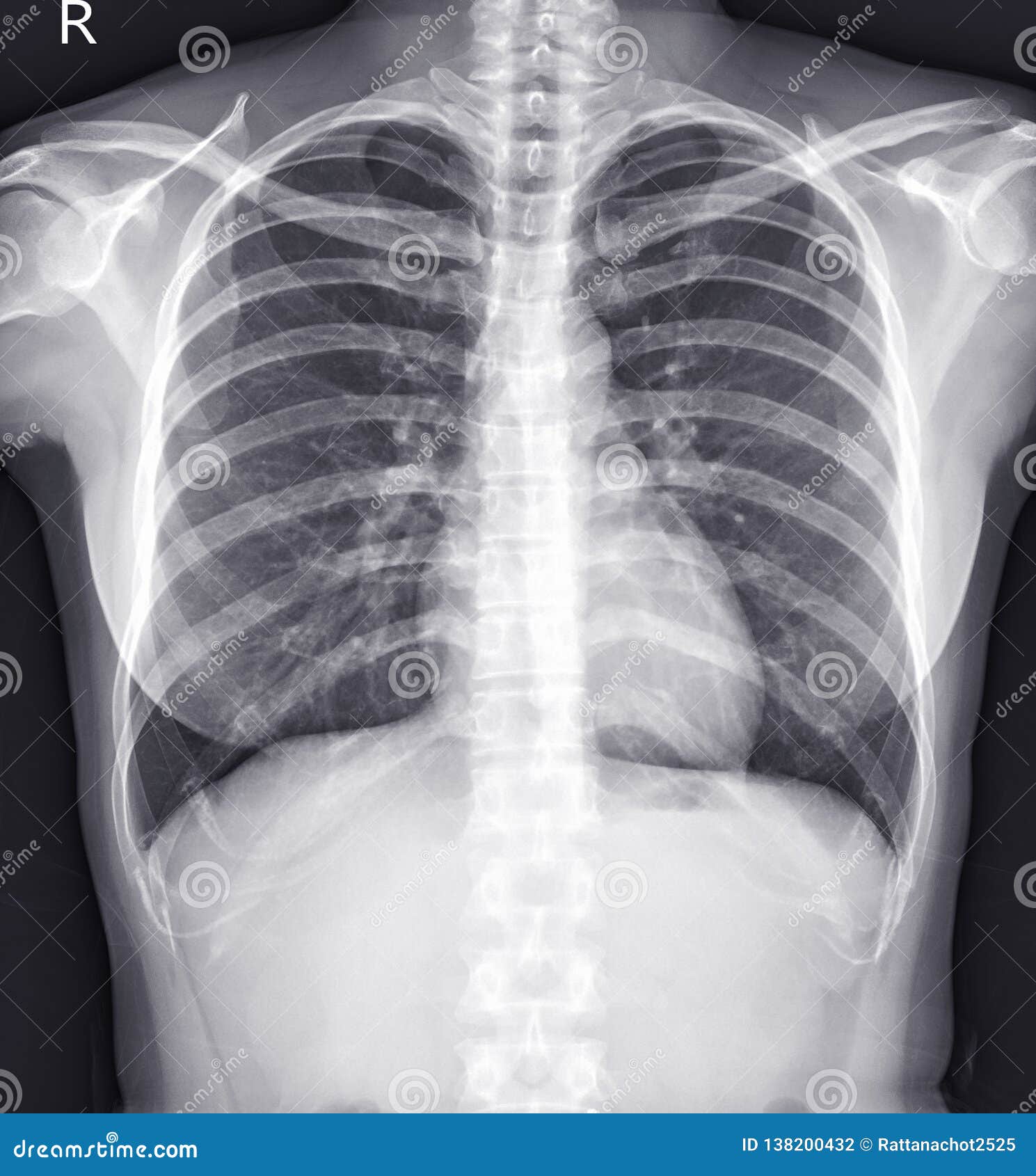 X Ray Chest Normal x-ray-chest-normal