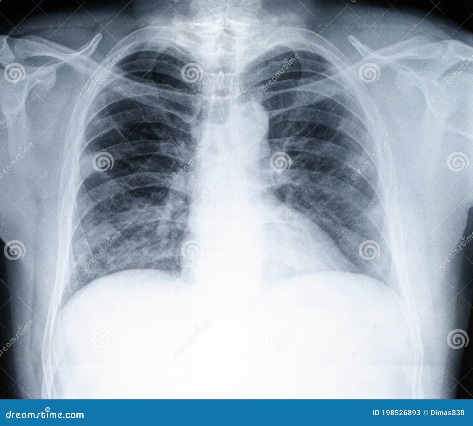Chest Xray of a Patient Covid 19 Stock Image Image of medicine