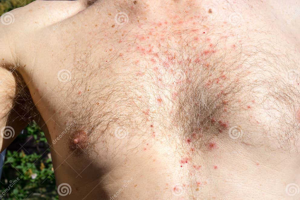 Chest Skin Rash As Drug Side Effect After Surgery Stock Image Image